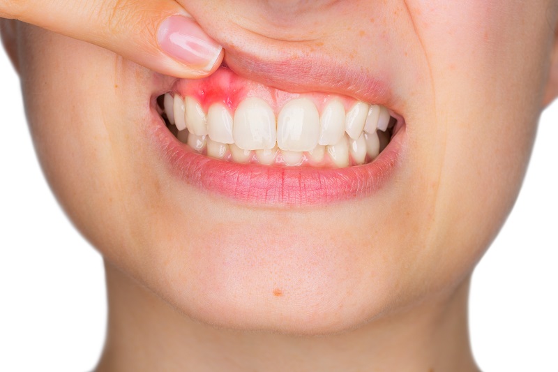 Why Are My Gums Receding